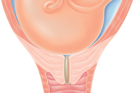 Illustration of fetus head pushing on effacing cervix
