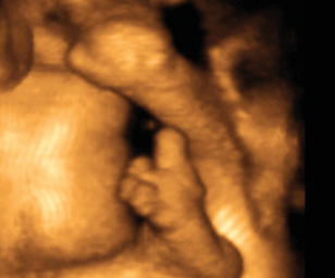 ultrasound of human fetus at 33 weeks and 4 days